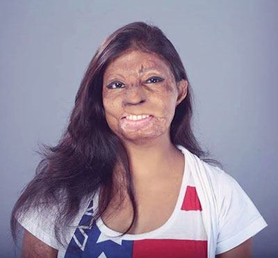 Acid Attack Survivors Pose As 'Calendar Girls' to Redefine Our Perspective Beauty