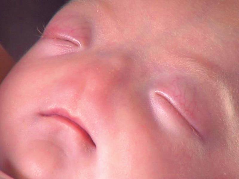 Baby Born with LifeThreatening Condition Left Him Without A Nose