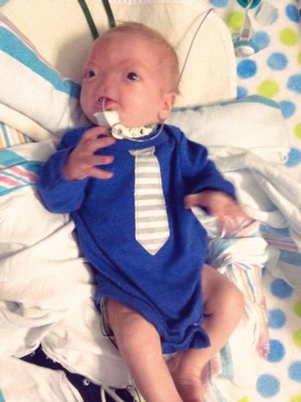 Baby Born with Life-Threatening Condition Left Him Without A Nose